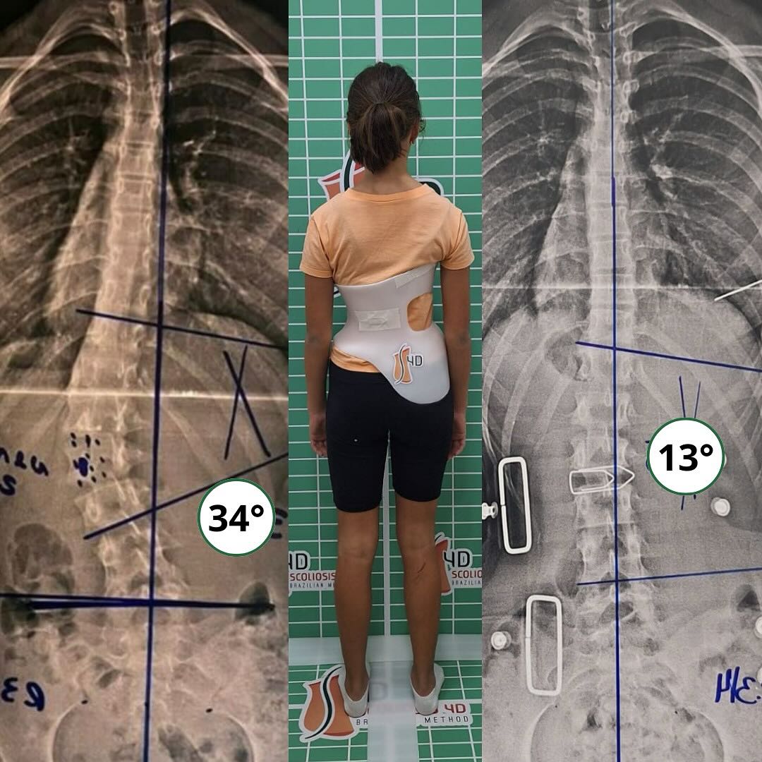 Resultado do tratamento: redução de 34° para 13°