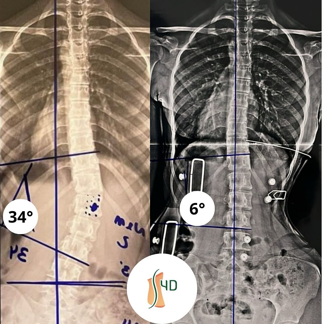 Resultado do tratamento: redução de 34° para 6°